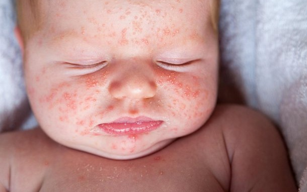 Trẻ nhỏ dễ bị phát ban sau khi sốt