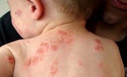Trẻ bị viêm da tiếp xúc cần kiêng gì?