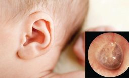 Viêm tai giữa thanh dịch gây gây ứ đọng dịch nhầy trong tai