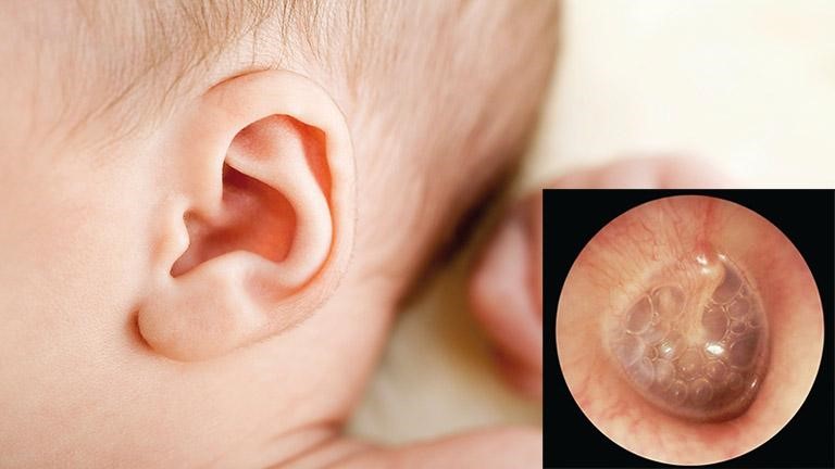 Bệnh gây ứ đọng dịch nhầy trong tai