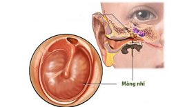 Viêm tai giữa xung huyết là bệnh gì?