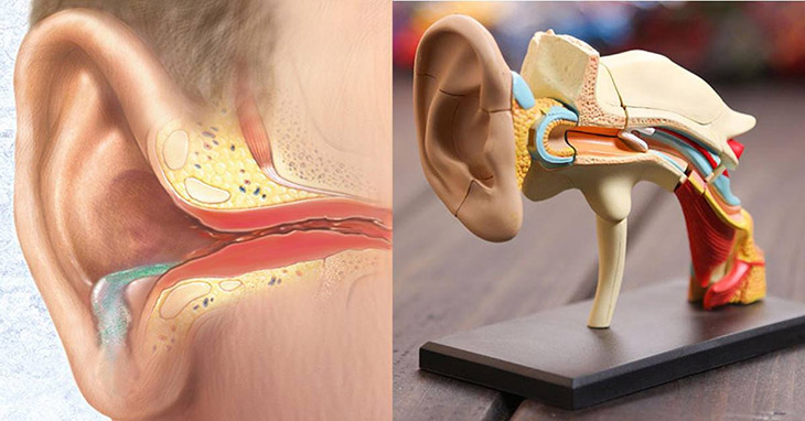 Bệnh viêm tai giữa gây ra biến chứng nguy hiểm