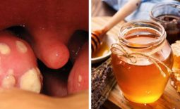 Chữa viêm amidan bằng mật ong được nhiều người bệnh tin tưởng sử dụng