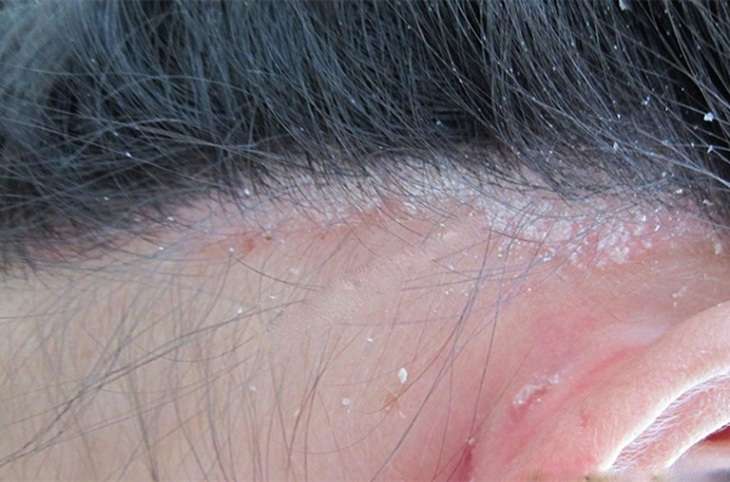 Da đầu ngứa, có vảy trắng có thể là do bệnh nấm da đầu