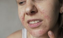 Viêm da tiết bã nhờn khiến da mặt bị ngứa và nổi sần