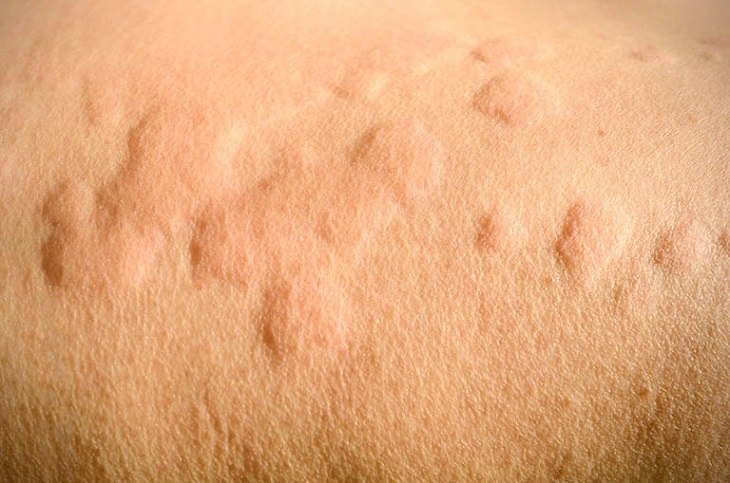 Mề đay là căn bệnh ngoài da phổ biến tại Việt Nam