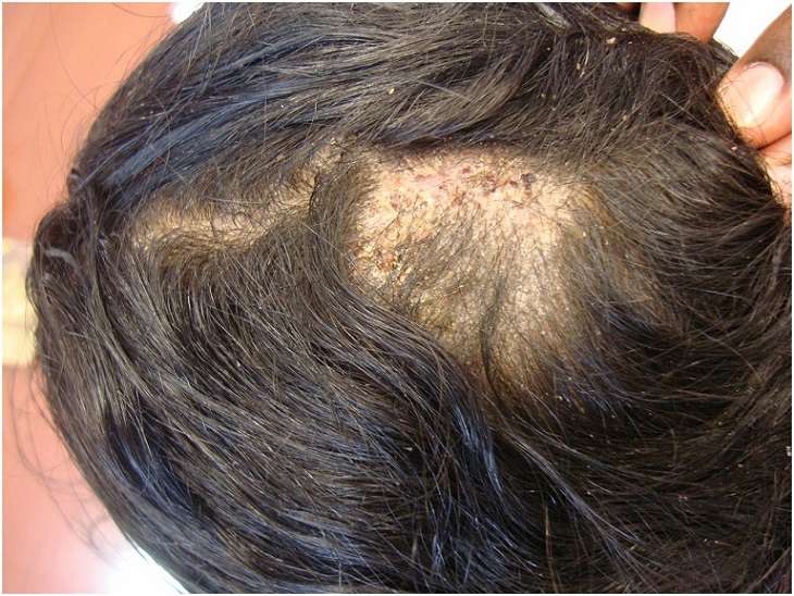 Nấm men khiến da bị bong tróc và rụng nhiều tóc