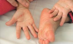 Ngứa kẽ chân kẽ tay là bệnh gì? Nguyên nhân và cách trị tốt nhất