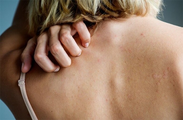 Do khó vệ sinh nên vùng lưng là bộ phận dễ bị bệnh ngoài da