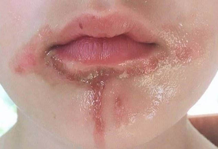 Ngứa quanh miệng cho bệnh chàm môi