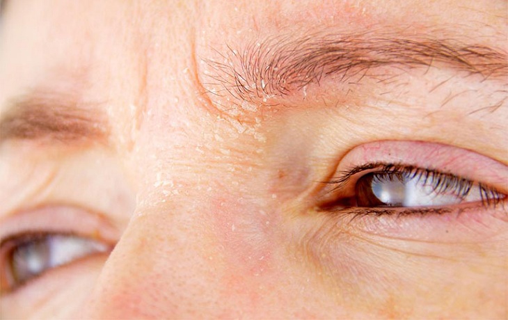 Vùng da quanh mắt bị khô ngứa gây khó chịu cho người bệnh