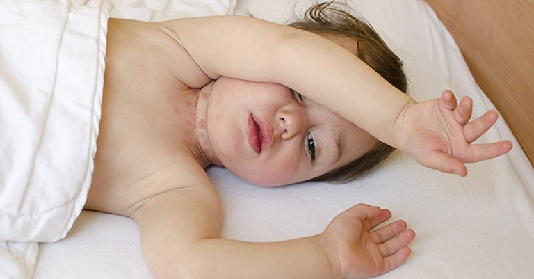 Trẻ bị mề đay tắm lá gì để giảm ngứa ngáy, khó chịu