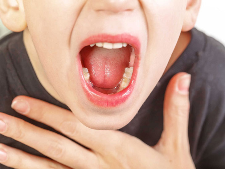 Viêm amidan quá phát ở trẻ là bệnh lý Tai-mũi-họng nguy hiểm