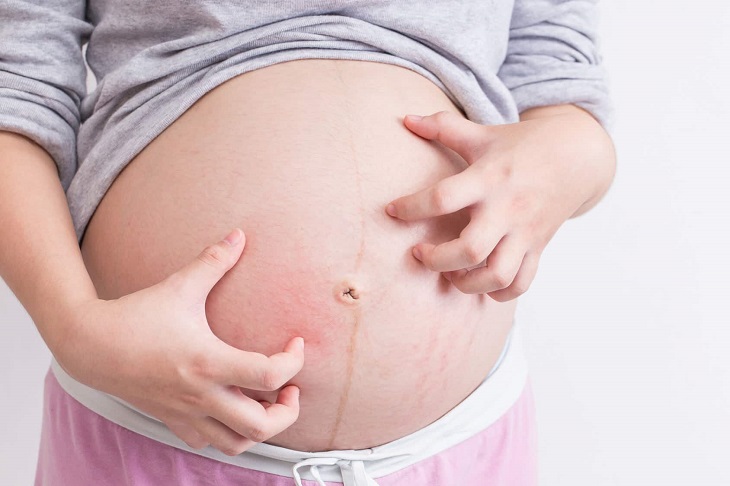 Nổi mề đay khi mang thai thường gây ngứa dữ dội