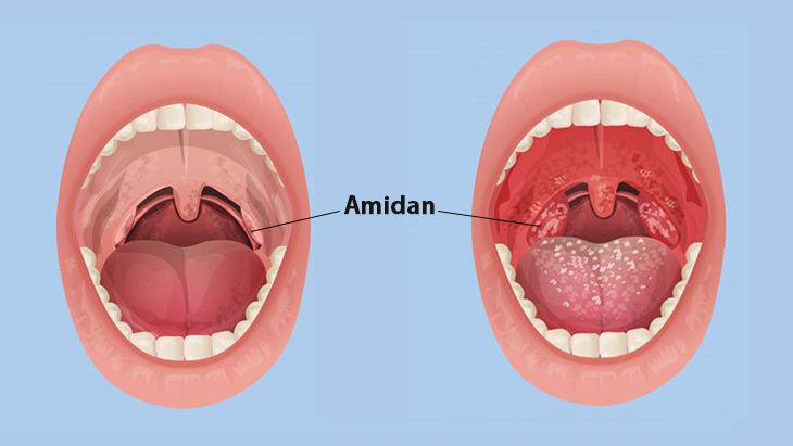 Hình ảnh amidan bị viêm