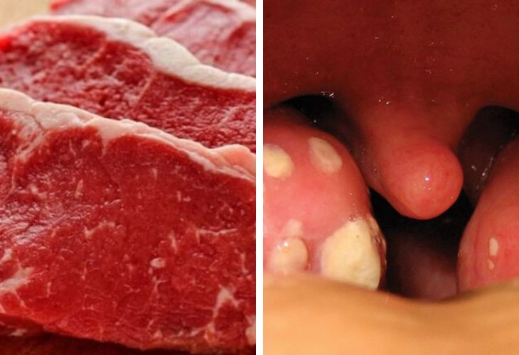 Bị viêm amidan ăn thịt bò được không được nhiều người bệnh quan tâm