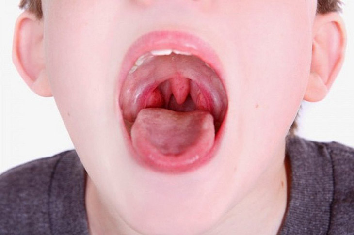 Viêm amidan ở trẻ - bệnh lý hô hấp thường gặp