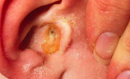 Các biến chứng nguy hiểm của bệnh viêm tai giữa có mủ