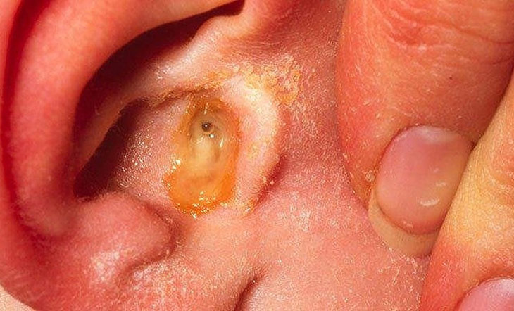 Các biến chứng nguy hiểm của bệnh viêm tai giữa có mủ