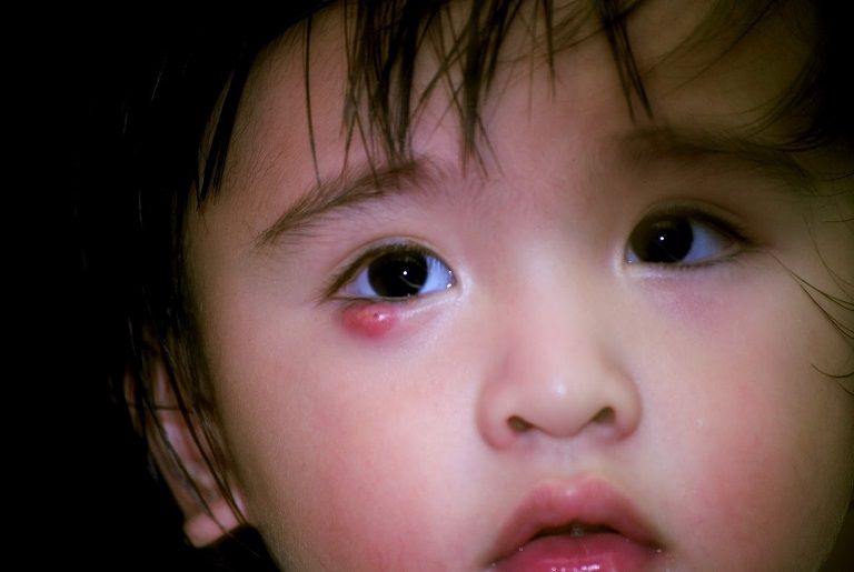 Bé bị nổi mẩn đỏ quanh mắt khiến bố mẹ lo lắng