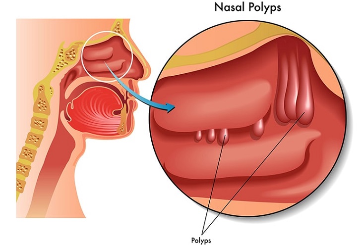 Dịch nhầy viêm xoang tích tụ rất dễ gây polyp mũi