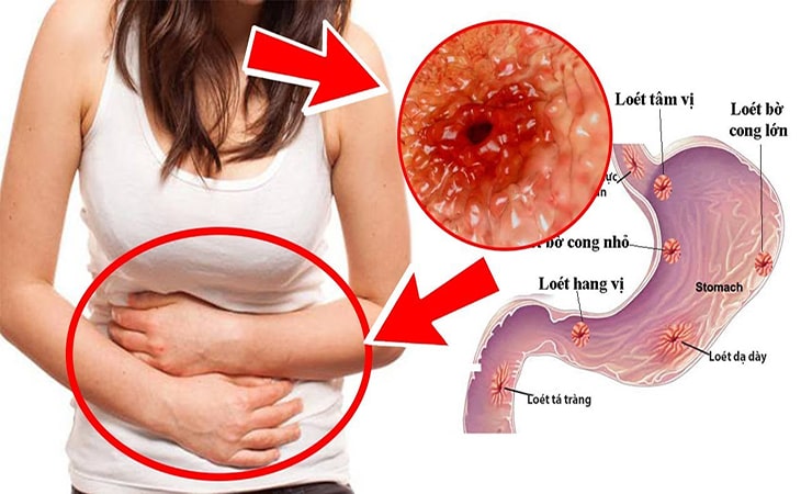 Đâu là những biến chứng viêm loét dạ dày?