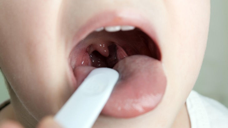 Cách chữa viêm họng hạt nhanh nhất bạn cần biết