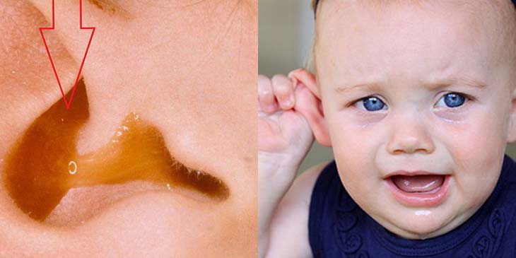 Xuất hiện dịch mủ bất thường trong tai trẻ chính là dấu hiệu thường thấy nhất