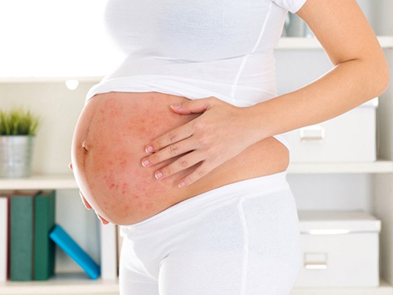Nổi mẩn đỏ do căng da thường gặp ở phụ nữ ở các tuần cuối thai kỳ
