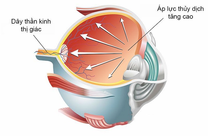 Ngứa mắt do viêm mũi dị ứng có thể làm tăng nhãn áp
