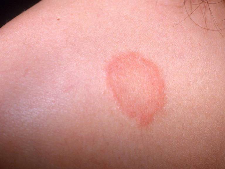 Mặt nổi mẩn đỏ như mụn là dấu hiệu gì Cách chữa trị  Drthaiha