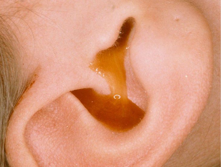 Khi dịch chảy kéo dài thì nên phẫu thuật viêm tai giữa mãn tính