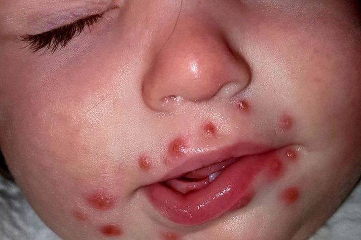 Nhiều phụ huynh thắc mắc trẻ bị nổi mẩn đỏ xung quanh miệng là bệnh gì?