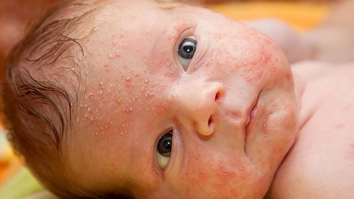 Trẻ sơ sinh bị nổi mẩn đỏ ở mặt do đâu?
