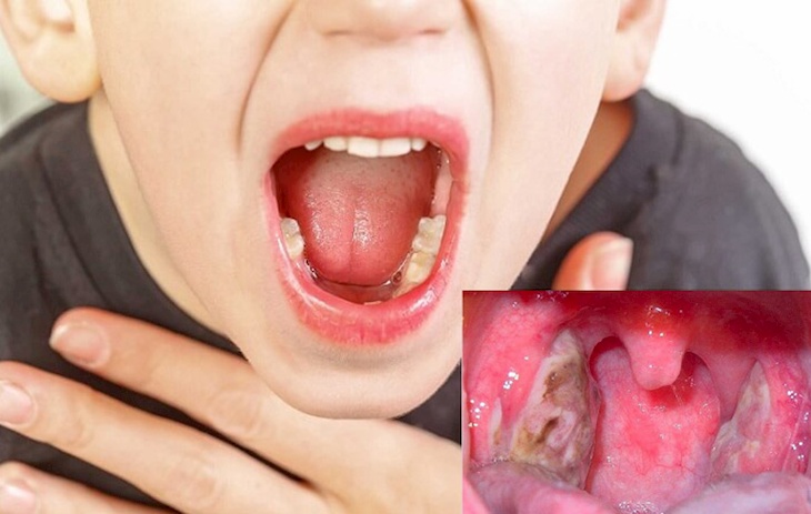 Viêm họng hạt có mủ là bệnh hô hấp thường gặp ở trẻ em