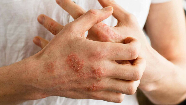 Bệnh viêm da cơ địa là bệnh lý mãn tính về da, có thể tái phát nhiều lần