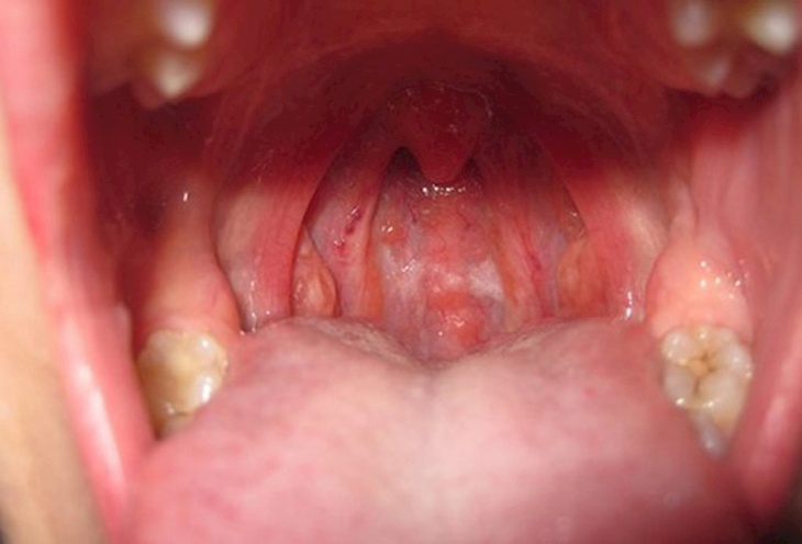 Sưng, đau rát cổ họng là triệu chứng thường gặp khi bị bệnh