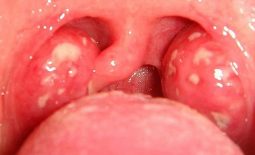 Viêm họng có đốm trắng - bệnh lý hô hấp nghiêm trọng 