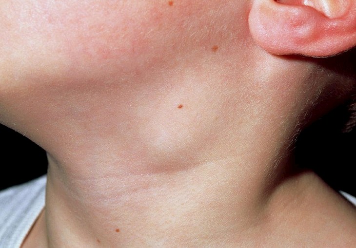 Viêm họng hạt bị nổi hạch là dấu hiệu của một số bệnh nguy hiểm