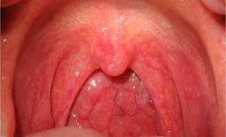 Viêm họng phù nề - tình trạng diễn tiến cấp tính của viêm họng thông thường 