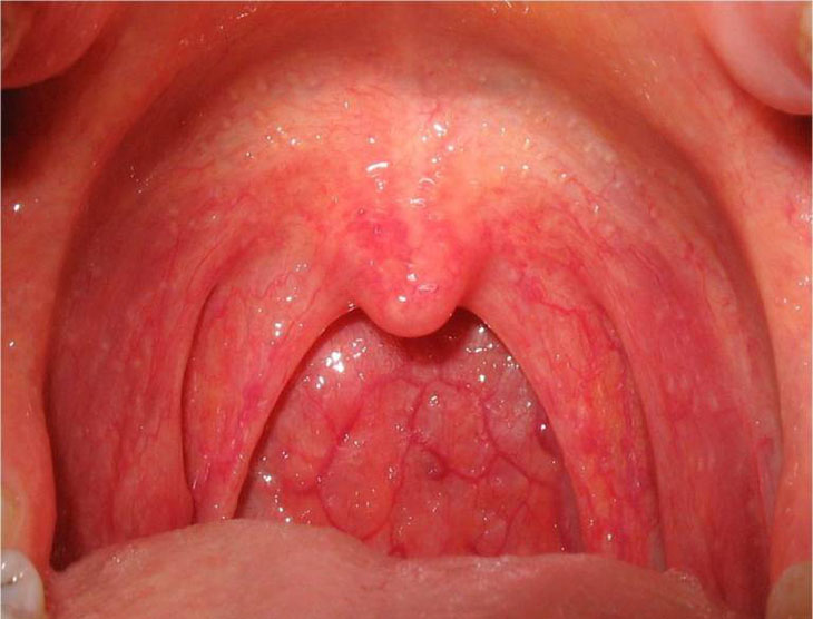 Viêm họng phù nề - tình trạng diễn tiến cấp tính của viêm họng thông thường 