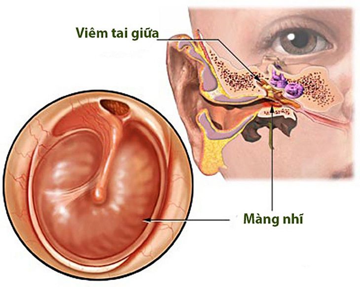 Bệnh viêm tai giữa có thể gây ra nhiều biến chứng nguy hiểm