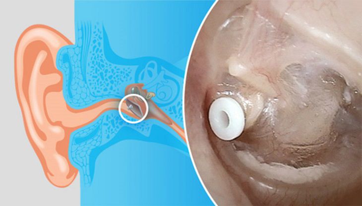 Sử dụng ống thông màng nhĩ là phương pháp chữa viêm tai giữa cho bé