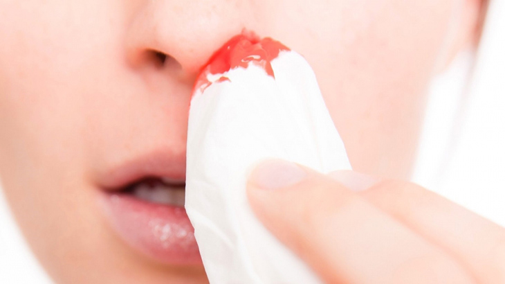 Viêm xoang chảy máu mũi là dấu hiệu cảnh báo tình trạng nguy hiểm