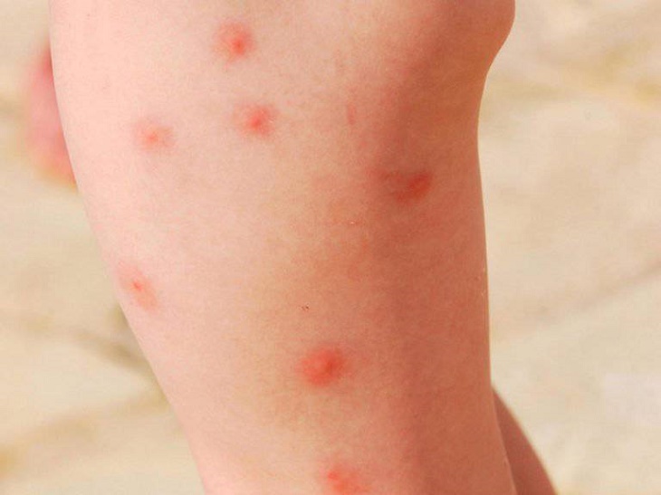 Hình ảnh bệnh ngoài da gây ngứa nổi mẩn đỏ như muỗi đốt