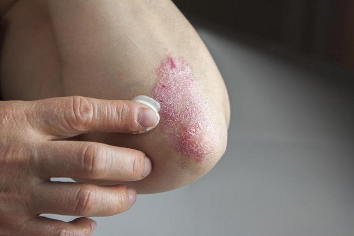 Dưỡng ẩm thường xuyên cho da, tránh tình trạng da bị nứt nẻ và bong tróc.