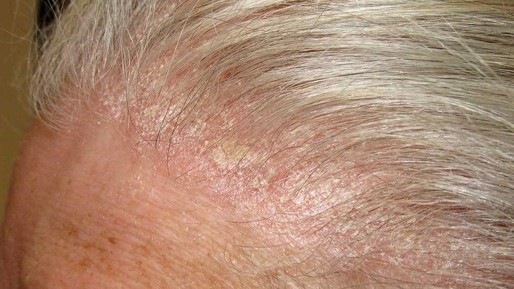Da đầu ngứa nổi mẩn đỏ là bệnh gì? Cảnh báo các bệnh phổ biến