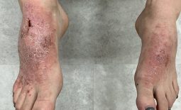 Khi vùng chân có tiền sử bị nhiễm trùng thường có nguy cơ mắc bệnh viêm da cơ địa ở chân khá cao