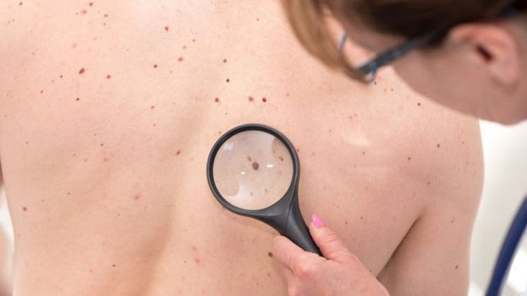 Các nốt sẫm màu dưới da có thể là dấu hiệu của ung thư máu