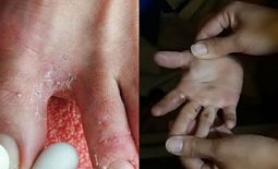 Bị nổi mẩn đỏ ngứa ở chân tay là bệnh lý gì? Mức độ nguy hiểm